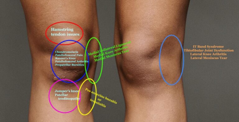 knee pain