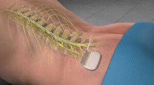 Recovery Time for Spinal Cord Stimulator Surgery