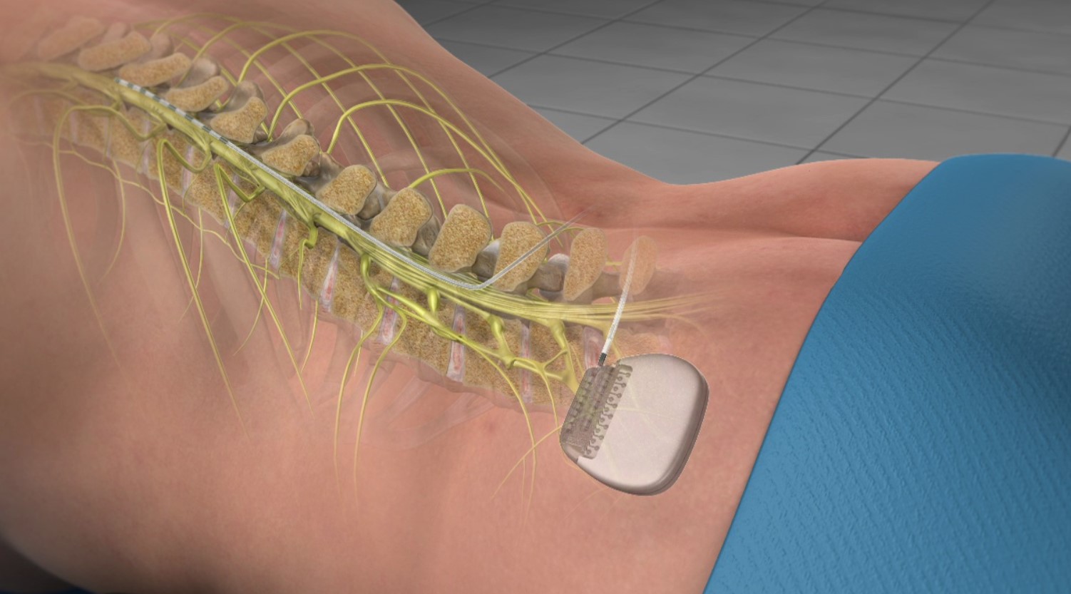 Recovery Time for Spinal Cord Stimulator Surgery
