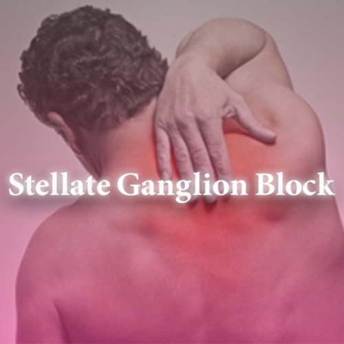 Stellate ganglion block